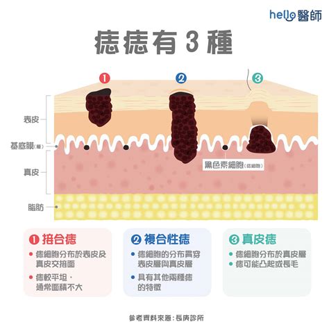 身體長痣的原因|痣是什麼？會變成黑色素瘤？7種一定要除的痣